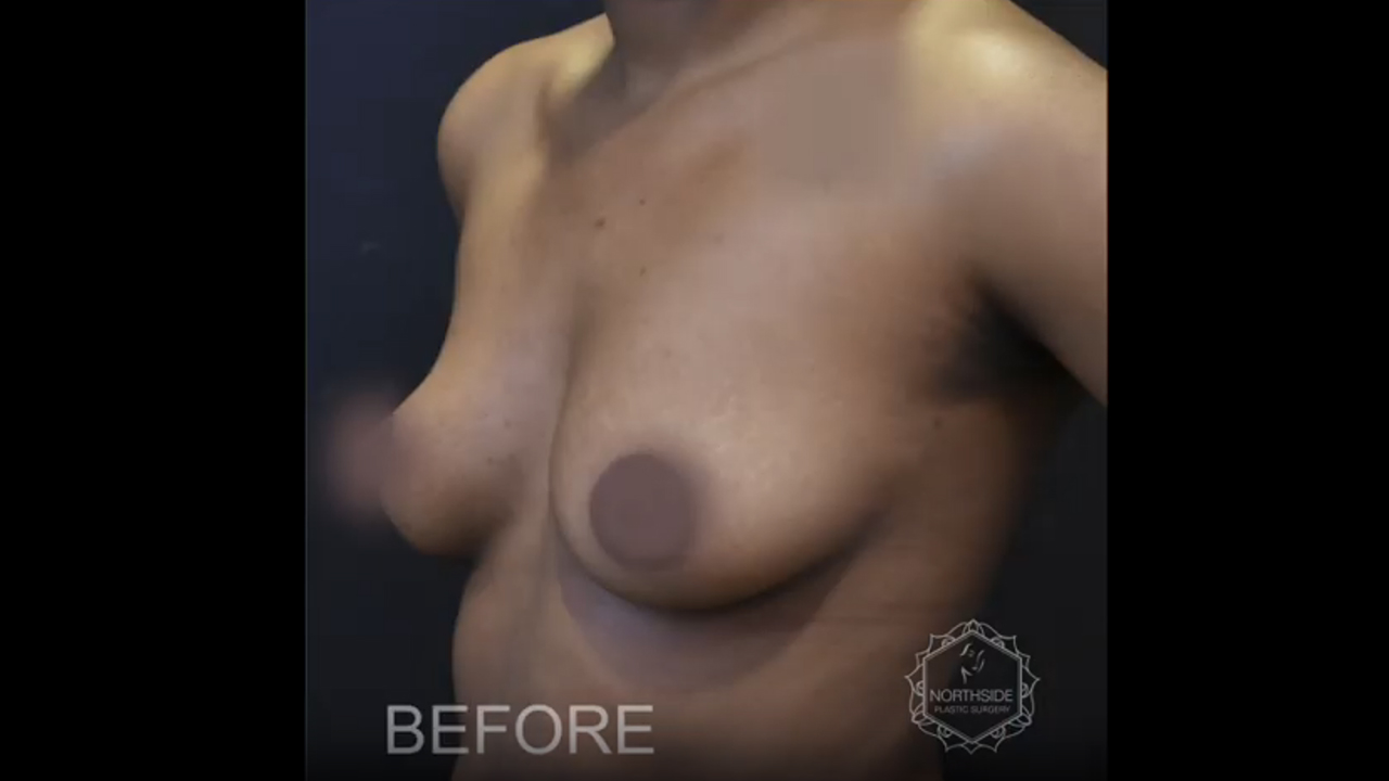 Breast Augmentation Atlanta