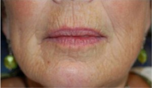 Perioral Dermabrasion Before and After | Northside Plastic Surgery
