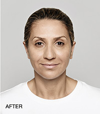 Restylane Before and After | Northside Plastic Surgery