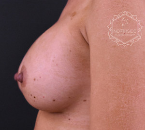 Breast Augmentation Before and After | Northside Plastic Surgery