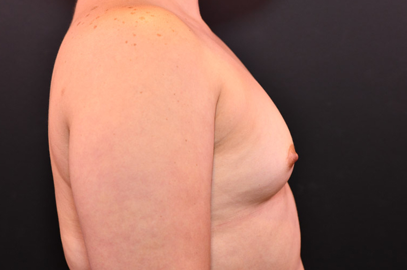 Breast Augmentation Before and After | Northside Plastic Surgery