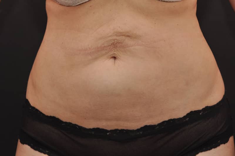 Liposuction Before and After | Northside Plastic Surgery