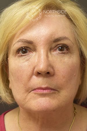 Natural Eyelid Surgery Before and After | Northside Plastic Surgery