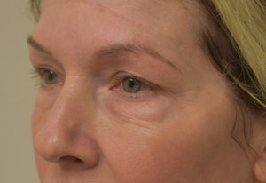 Natural Eyelid Surgery Before and After | Northside Plastic Surgery