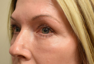 Natural Eyelid Surgery Before and After | Northside Plastic Surgery