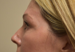 Natural Eyelid Surgery Before and After | Northside Plastic Surgery