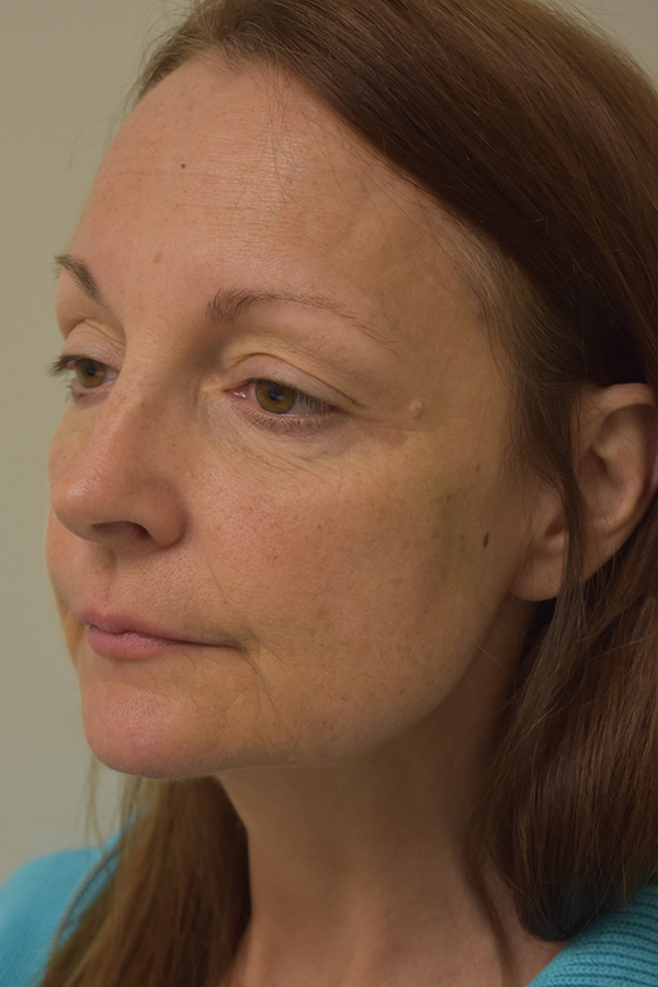 Natural Eyelid Surgery Before and After | Northside Plastic Surgery