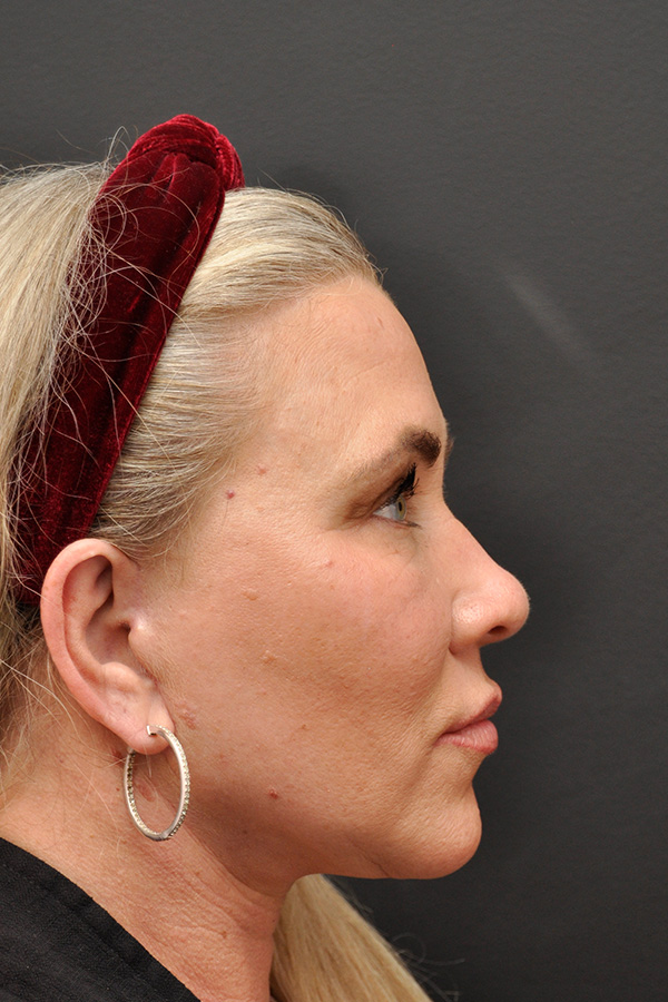 Natural Facelift Before and After | Northside Plastic Surgery