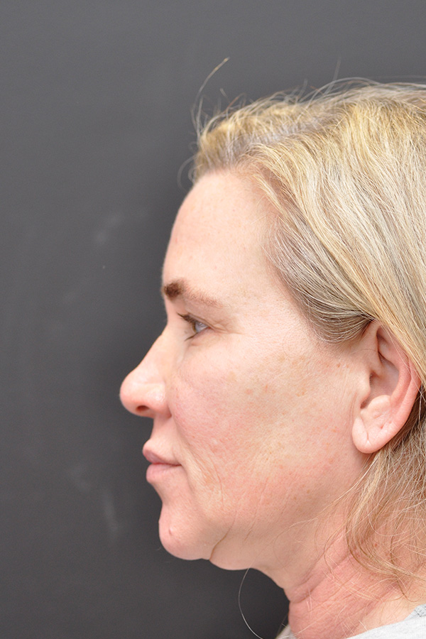 Natural Facelift Before and After | Northside Plastic Surgery