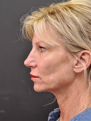 Natural Facelift Before and After | Northside Plastic Surgery