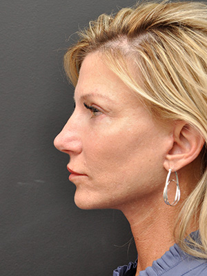 Natural Facelift Before and After | Northside Plastic Surgery