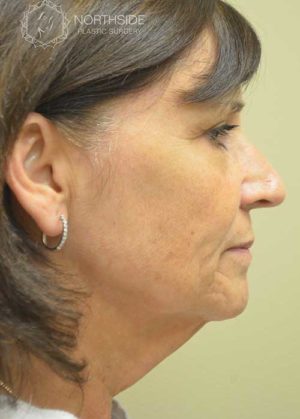 Natural Facelift Before and After | Northside Plastic Surgery