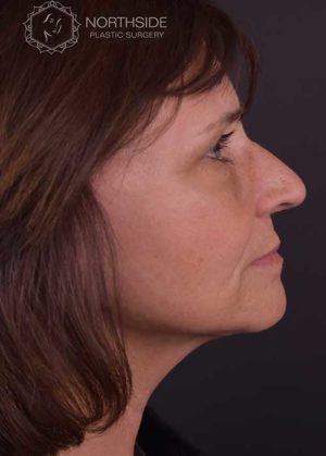 Natural Facelift Before and After | Northside Plastic Surgery