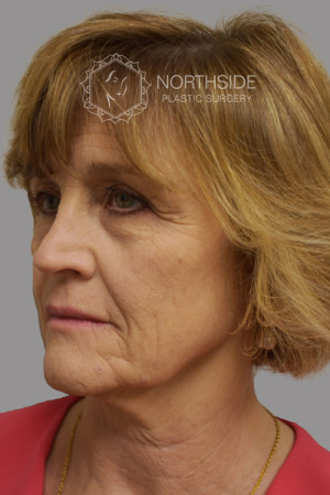 Natural Facelift Before and After | Northside Plastic Surgery