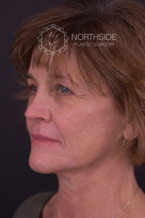 Natural Facelift Before and After | Northside Plastic Surgery