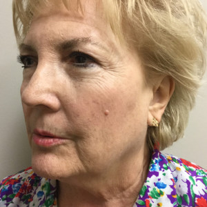 Natural Facelift Before and After | Northside Plastic Surgery