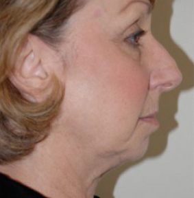 Natural Facelift Before and After | Northside Plastic Surgery