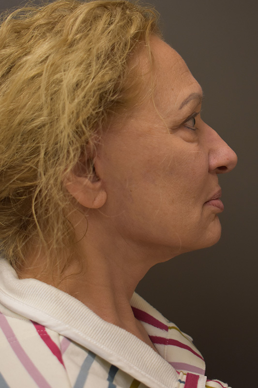 Natural Facelift Before and After | Northside Plastic Surgery