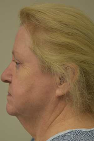 Natural Facelift Before and After | Northside Plastic Surgery