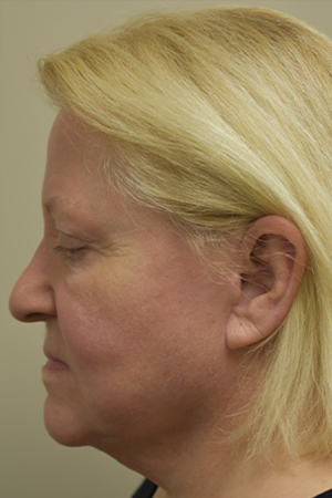 Natural Facelift Before and After | Northside Plastic Surgery