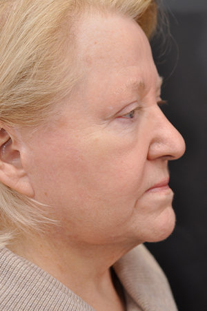 Natural Facelift Before and After | Northside Plastic Surgery