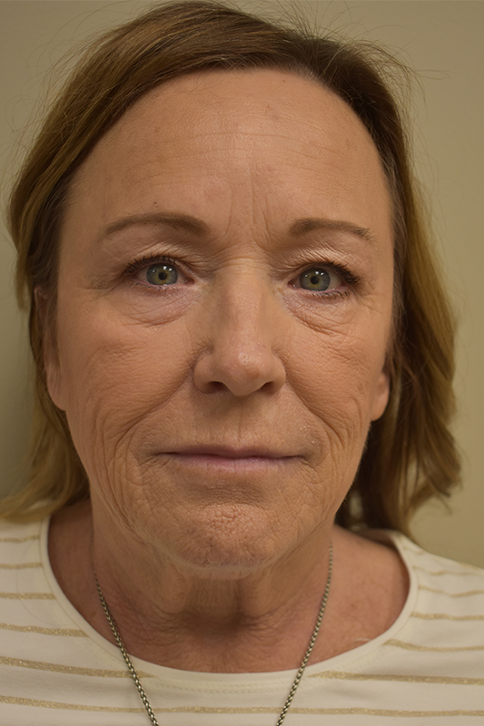 Natural Facelift Before and After | Northside Plastic Surgery