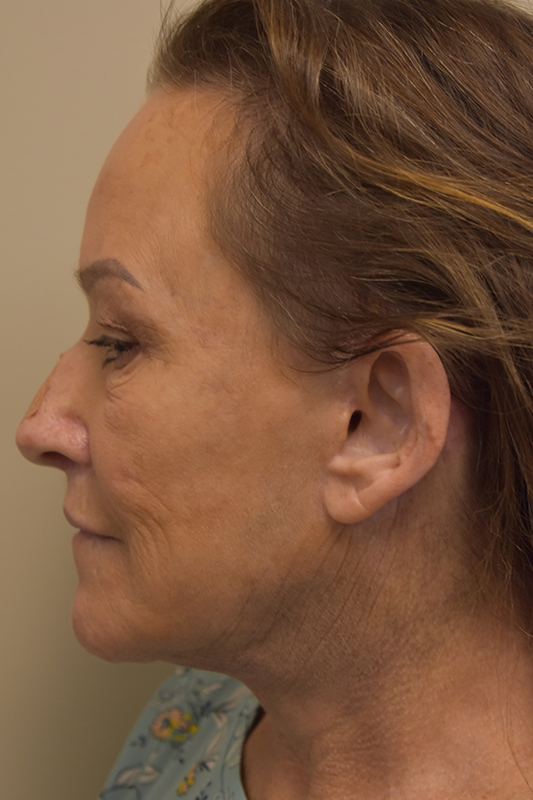 Natural Facelift Before and After | Northside Plastic Surgery