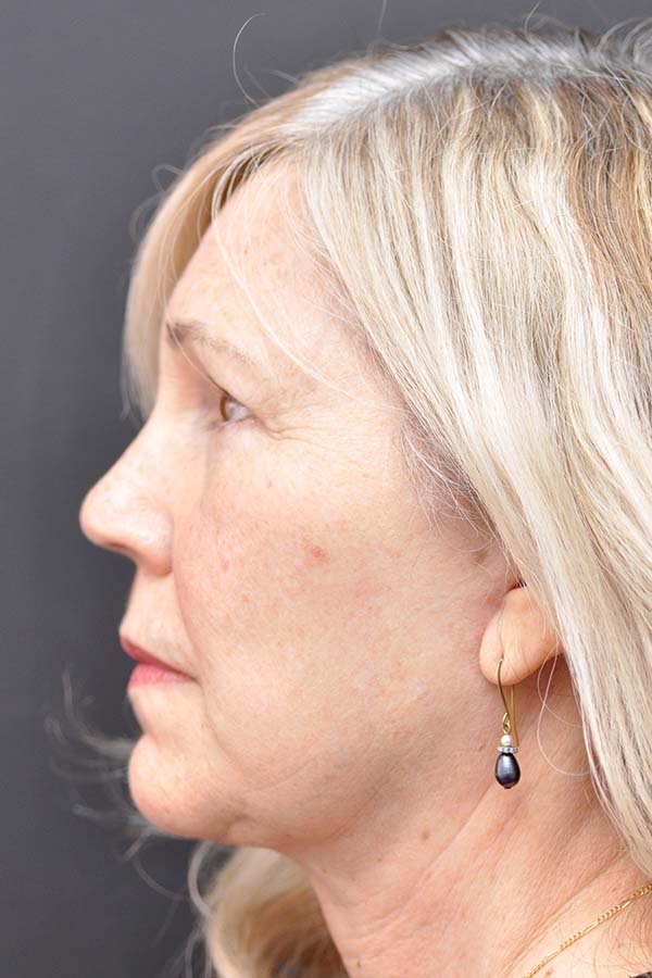 Natural Facelift Before and After | Northside Plastic Surgery