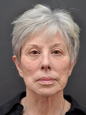 Natural Facelift Before and After | Northside Plastic Surgery