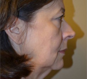 Natural Facelift Before and After | Northside Plastic Surgery
