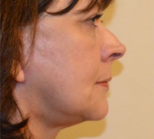 Natural Facelift Before and After | Northside Plastic Surgery