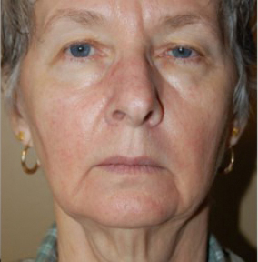 Natural Facelift Before and After | Northside Plastic Surgery