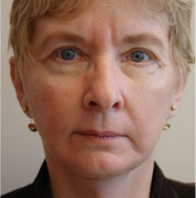 Natural Facelift Before and After | Northside Plastic Surgery