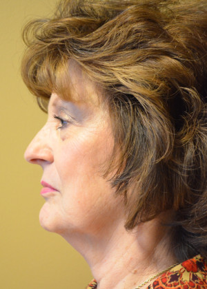 Natural Facelift Before and After | Northside Plastic Surgery