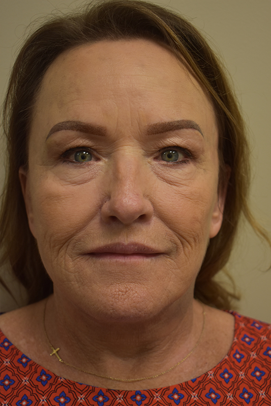 Natural Facelift Before and After | Northside Plastic Surgery