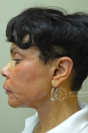 Natural Mini Facelift Before and After | Northside Plastic Surgery