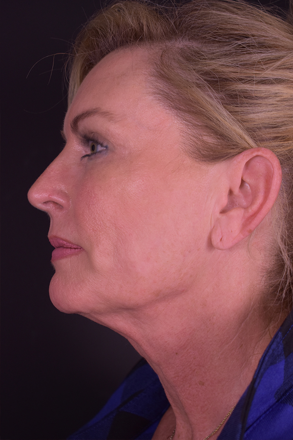 Perioral Dermabrasion Before and After | Northside Plastic Surgery