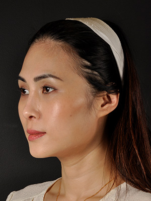 Rhinoplasty Before and After | Northside Plastic Surgery