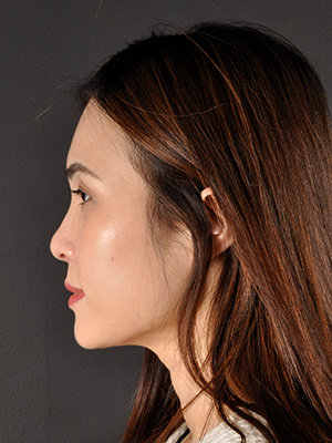 Rhinoplasty Before and After | Northside Plastic Surgery