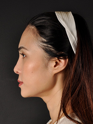 Rhinoplasty Before and After | Northside Plastic Surgery