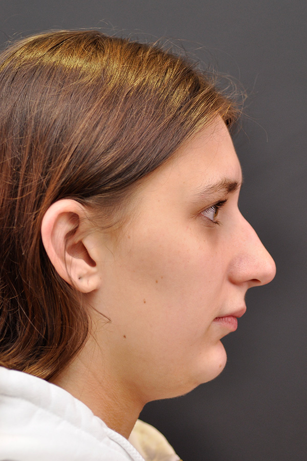 Rhinoplasty Before and After | Northside Plastic Surgery