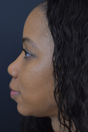 Rhinoplasty Before and After | Northside Plastic Surgery