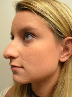 Rhinoplasty Before and After | Northside Plastic Surgery