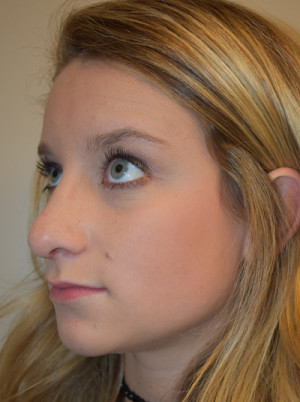 Rhinoplasty Before and After | Northside Plastic Surgery