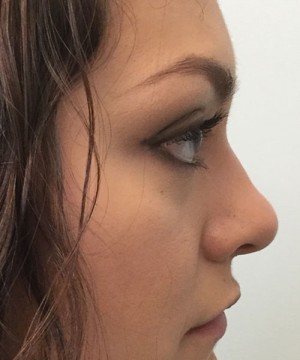 Rhinoplasty Before and After | Northside Plastic Surgery