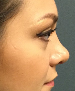 Rhinoplasty Before and After | Northside Plastic Surgery