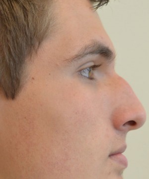 Rhinoplasty Before and After | Northside Plastic Surgery