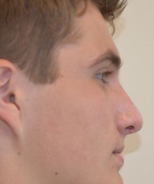 Rhinoplasty Before and After | Northside Plastic Surgery