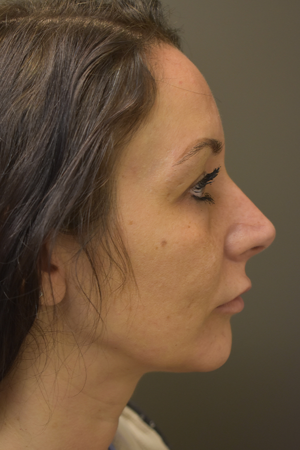 Rhinoplasty Before and After | Northside Plastic Surgery