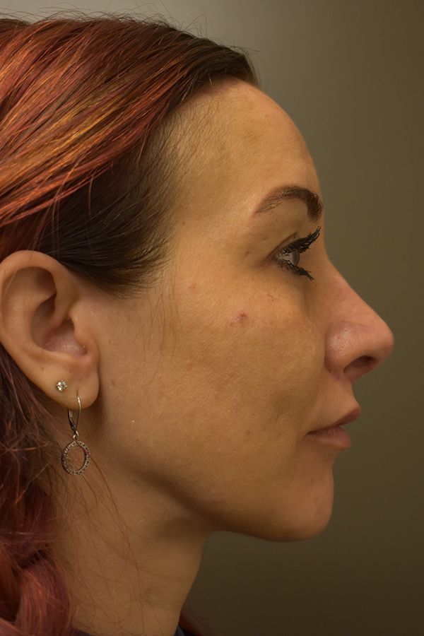 Rhinoplasty Before and After | Northside Plastic Surgery